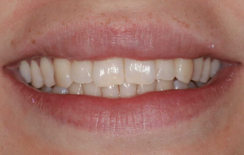 After - Mill Hill Dental Practice