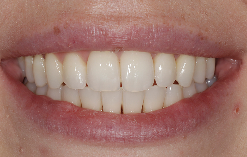 After - Mill Hill Dental Practice